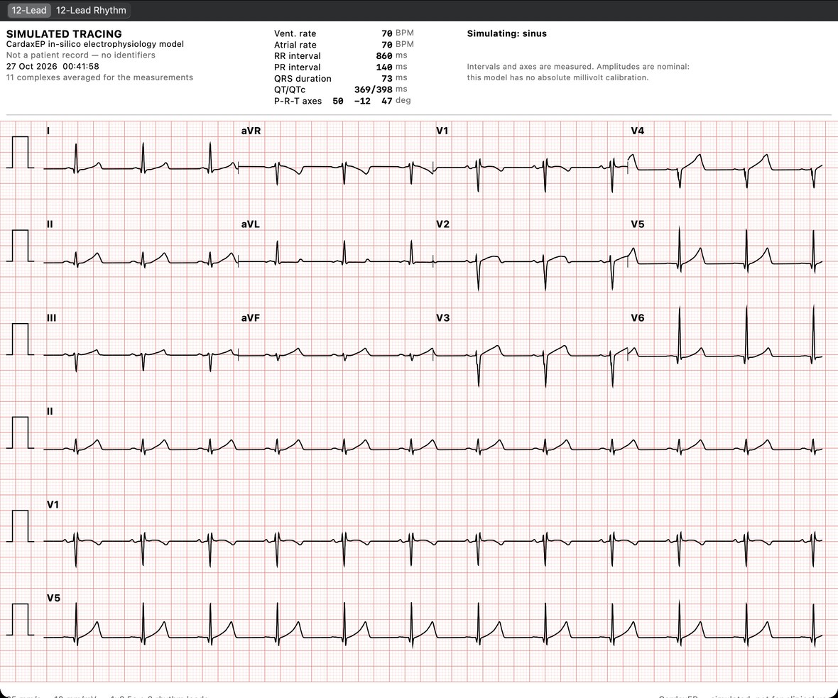Simulated twelve-lead ECG in sinus rhythm on standard ECG paper with measured rate, intervals, and axes